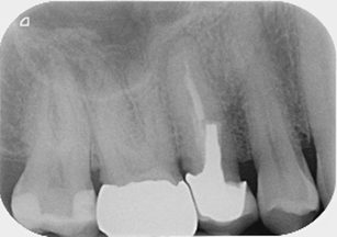 Molar endodontics - Pre-op case 2
